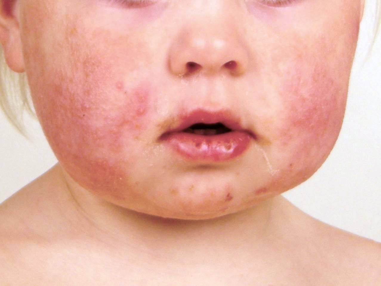 Viral Rashes in Babies